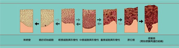 圖2 : 形成惡性腫瘤前的細胞變異過程（source：NCI Division of Cancer Prvention）